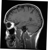 MRI scan of the head